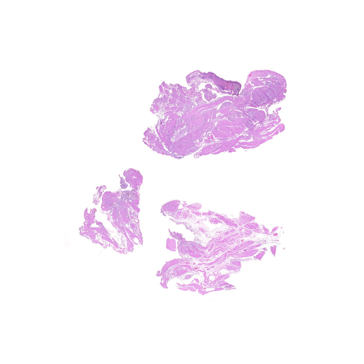 Human FFPE NAT Bladder Tissue HuN-03-0035