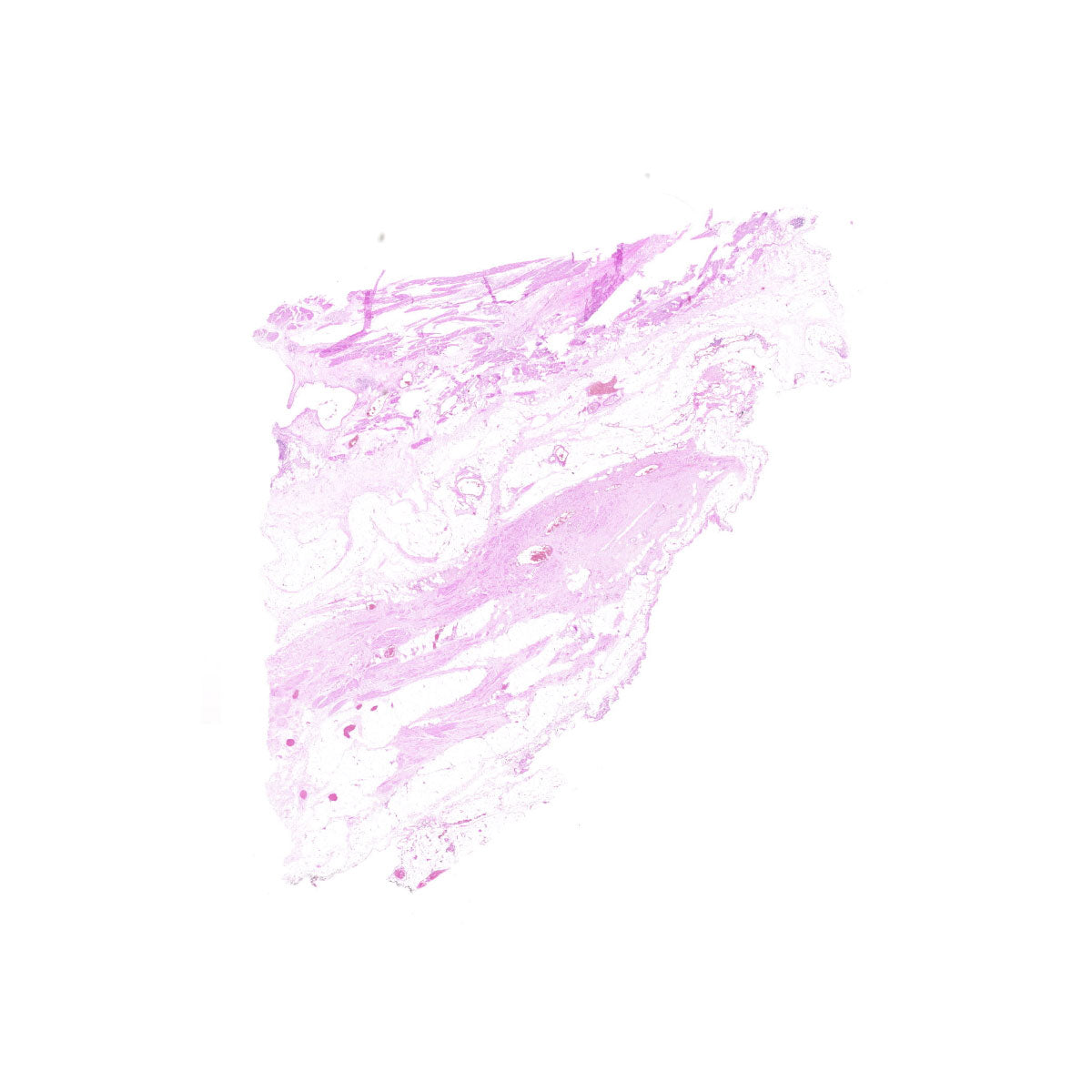 Human FFPE NAT Bladder Tissue HuN-03-0043B