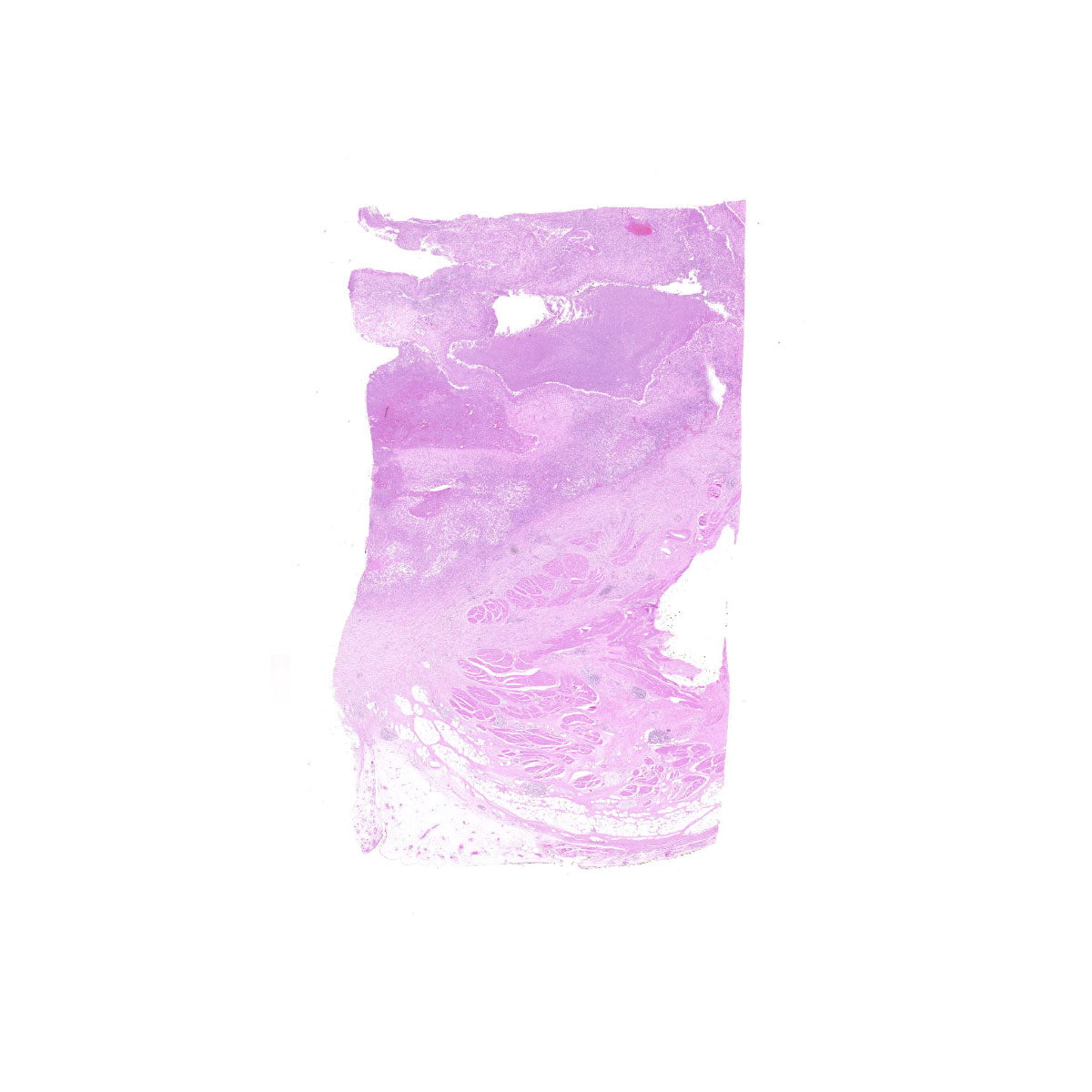 Human FFPE NAT Bladder Tissue HuN-03-0064B