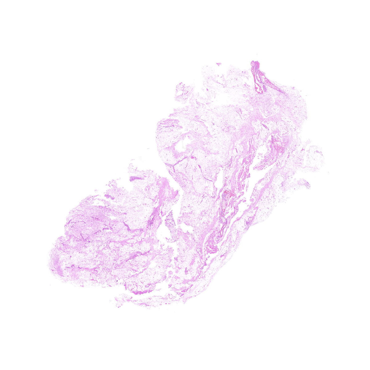 Human FFPE NAT Breast Tissue HuN-06-0044