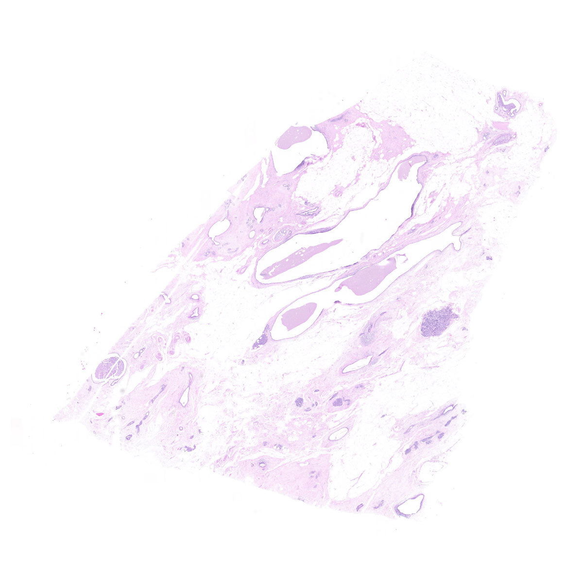 Human FFPE NAT Breast Tissue HuN-06-0051A