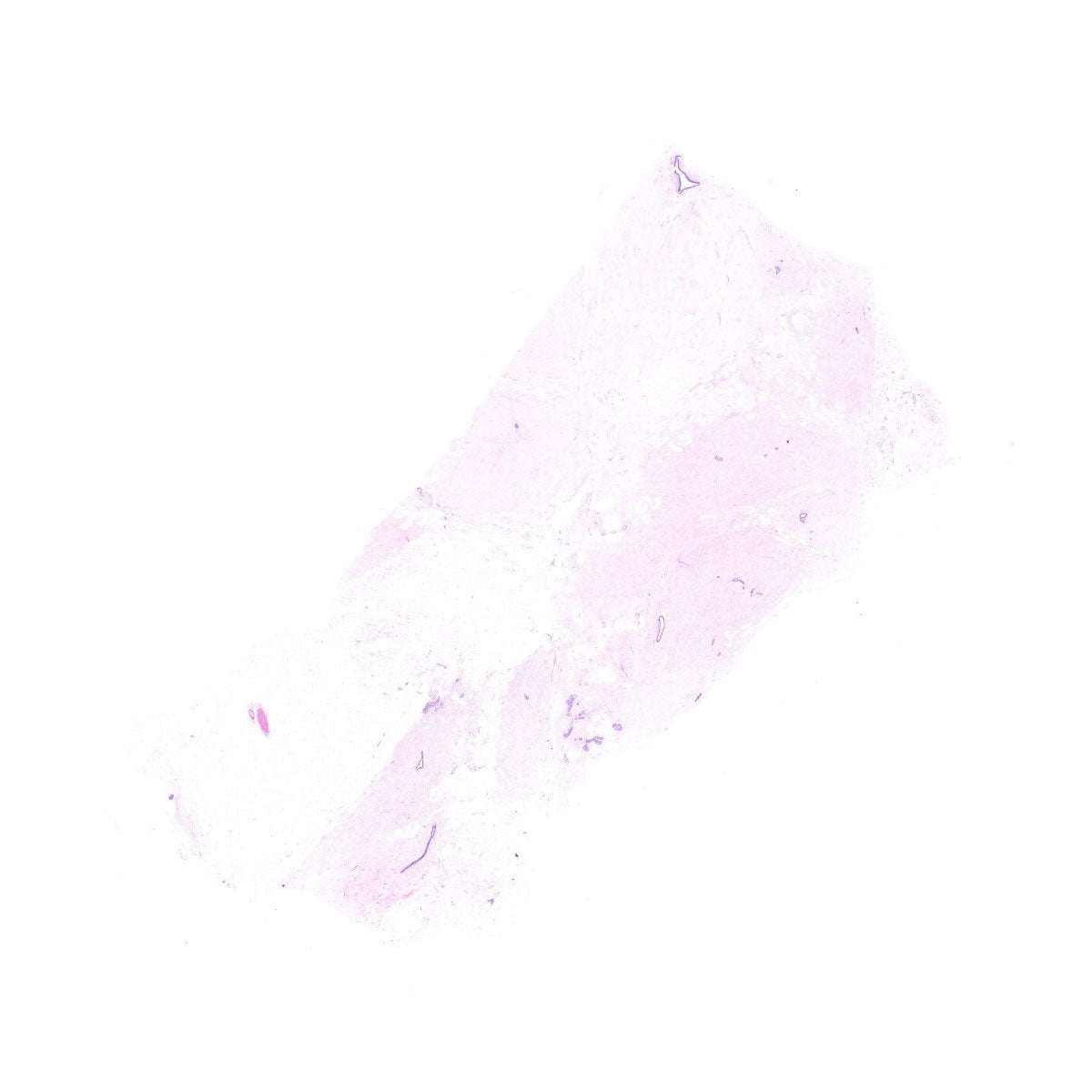 Human FFPE NAT Breast Tissue HuN-06-0053A