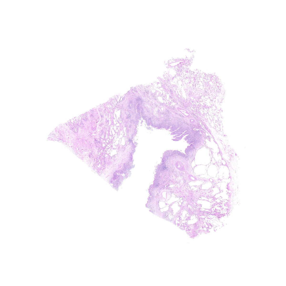 Human FFPE NAT Lung Tissue HuN-15-0063A