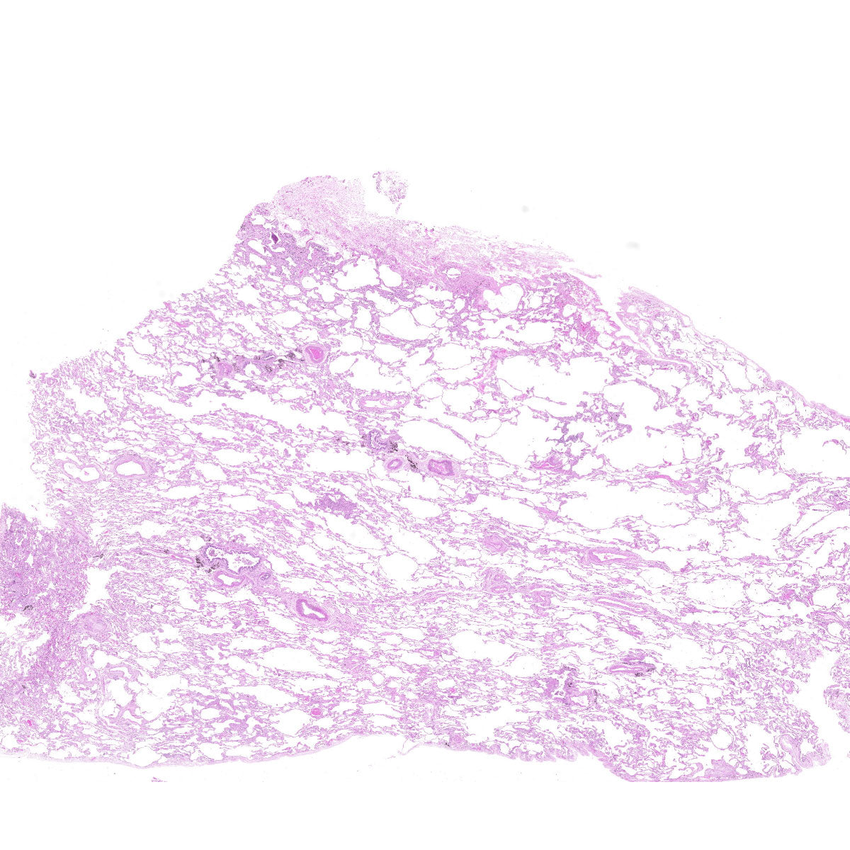 Human FFPE NAT Lung Tissue HuN-15-0115A