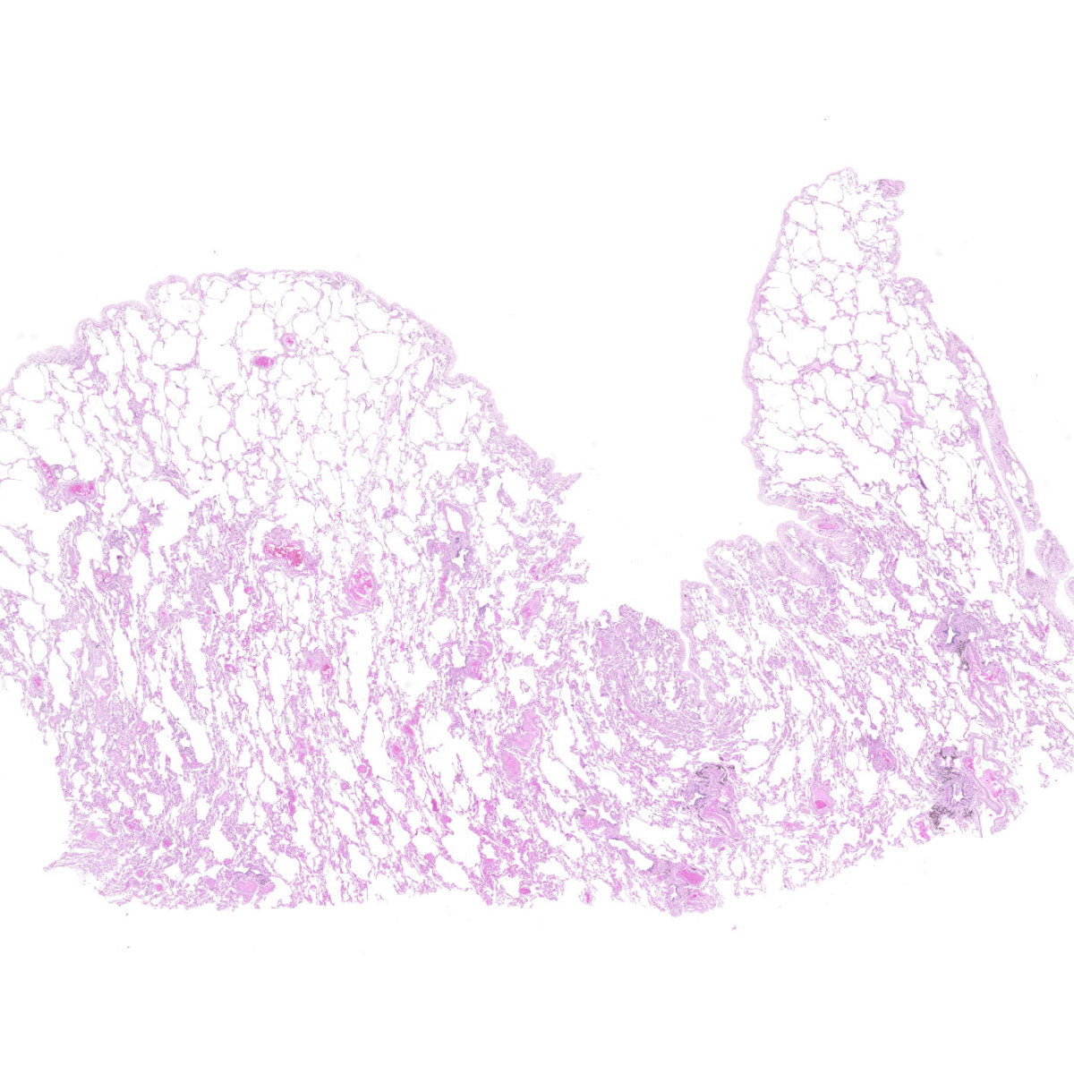 Human FFPE NAT Lung Tissue HuN-15-0132