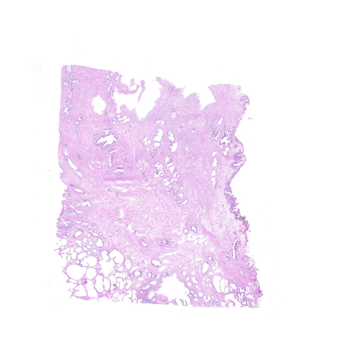 Human FFPE NAT Prostate Tissue HuN-21-0017B