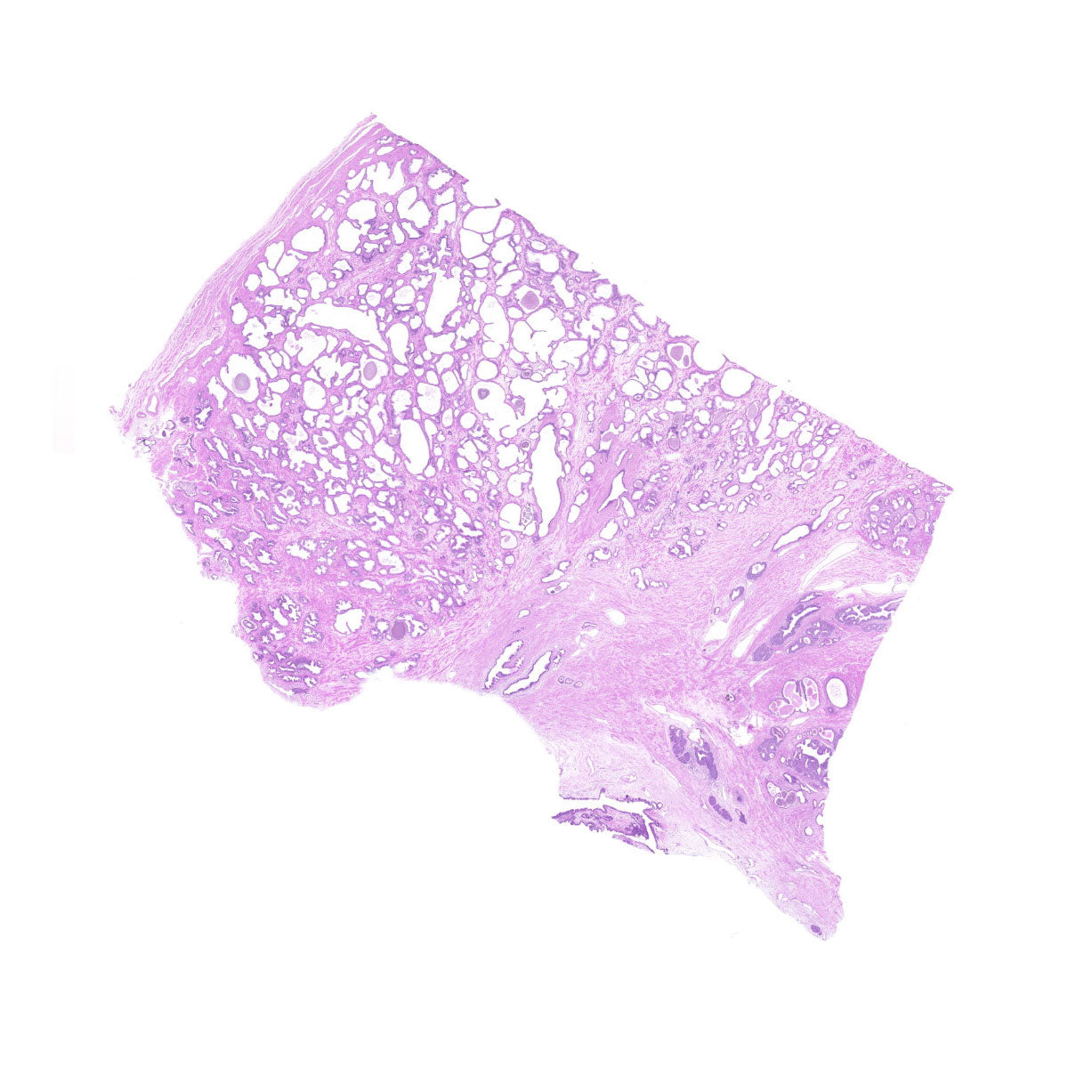 Human FFPE NAT Prostate Tissue HuN-21-0018A