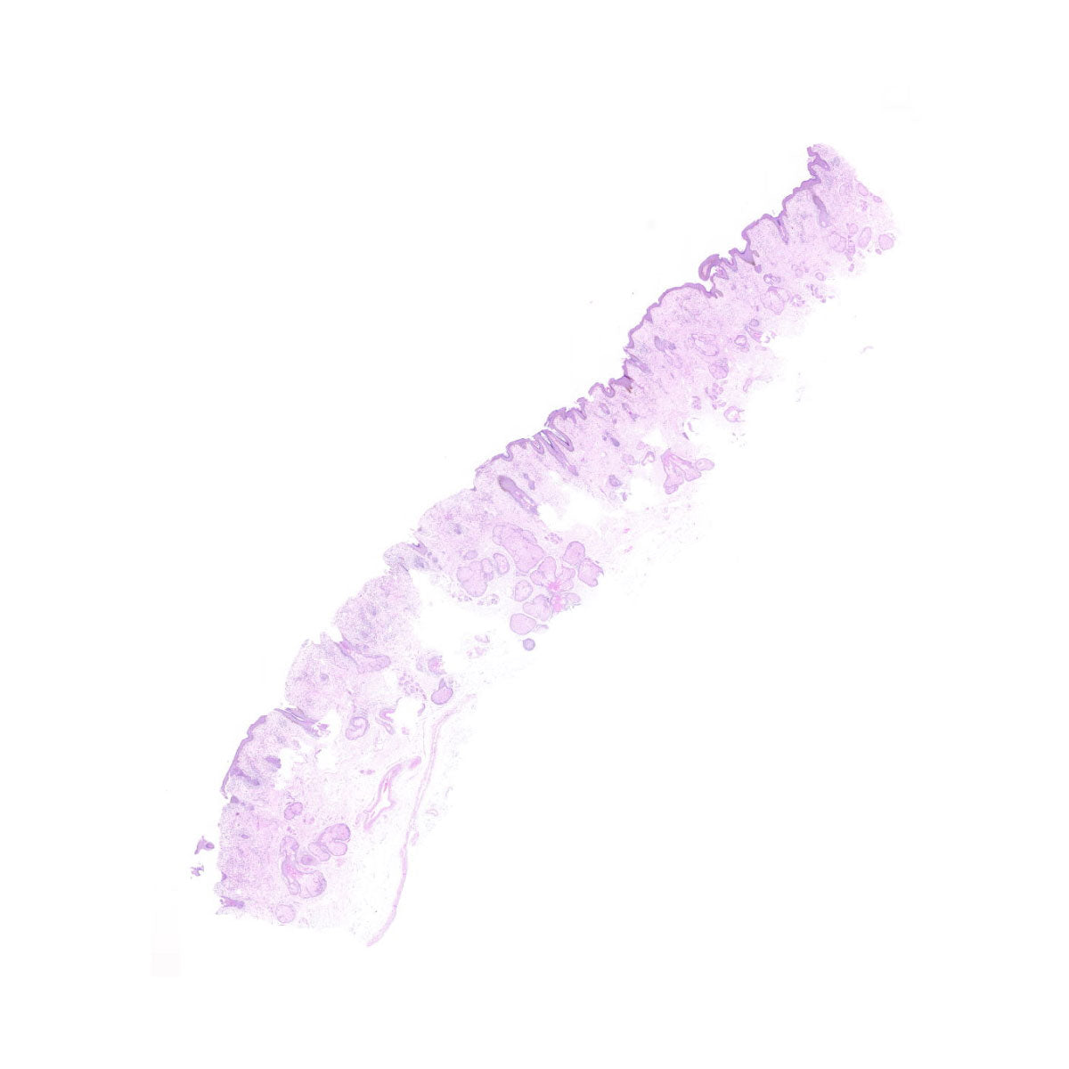 Human FFPE NAT Skin Tissue HuN-22-0062A
