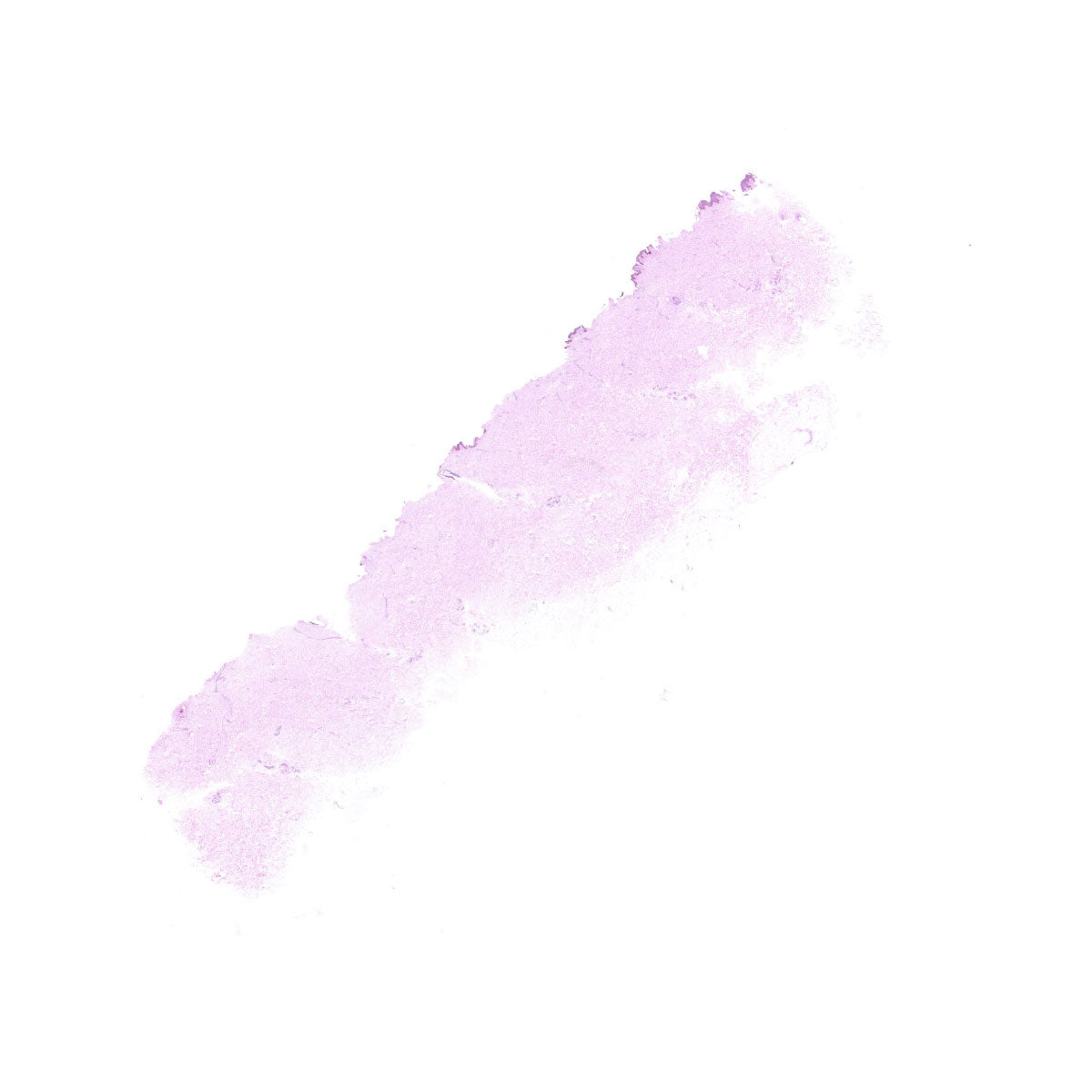 Human FFPE NAT Skin Tissue HuN-22-0066B