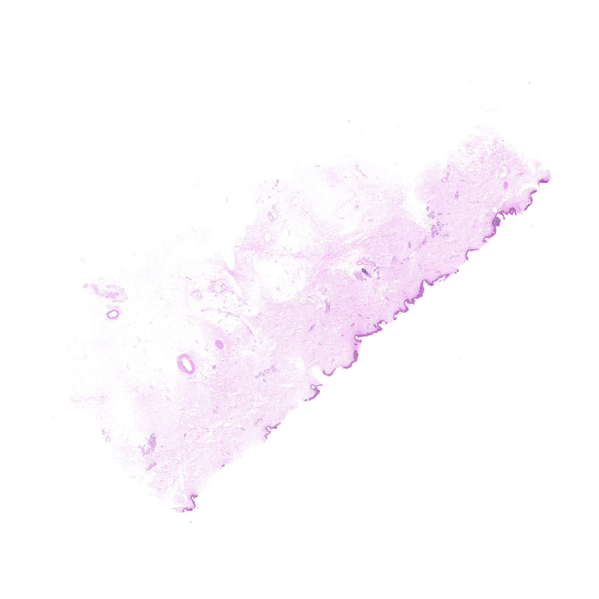 Human FFPE NAT Skin Tissue HuN-22-0069A