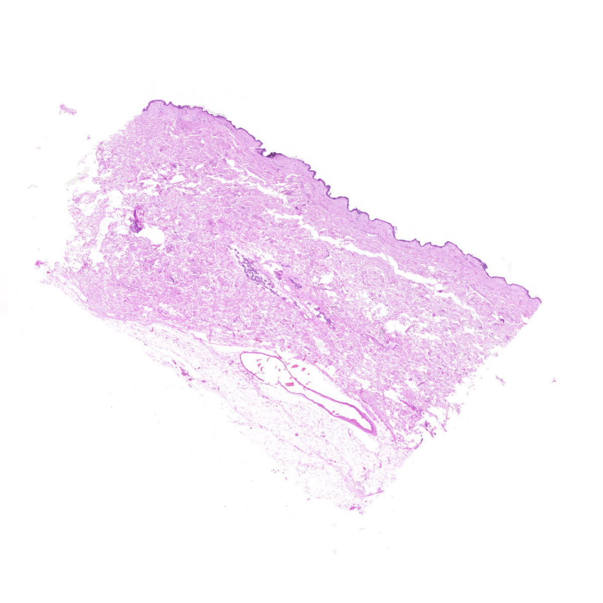 Human FFPE NAT Skin Tissue HuN-22-0087B