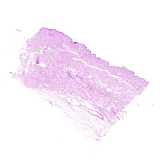 Human FFPE NAT Skin Tissue HuN-22-0087B