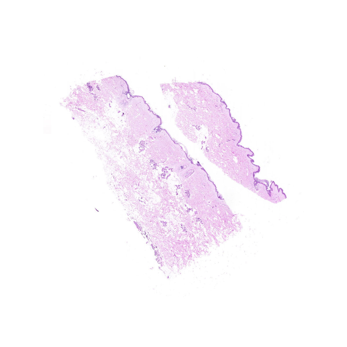 Human FFPE NAT Skin Tissue HuN-22-0090A