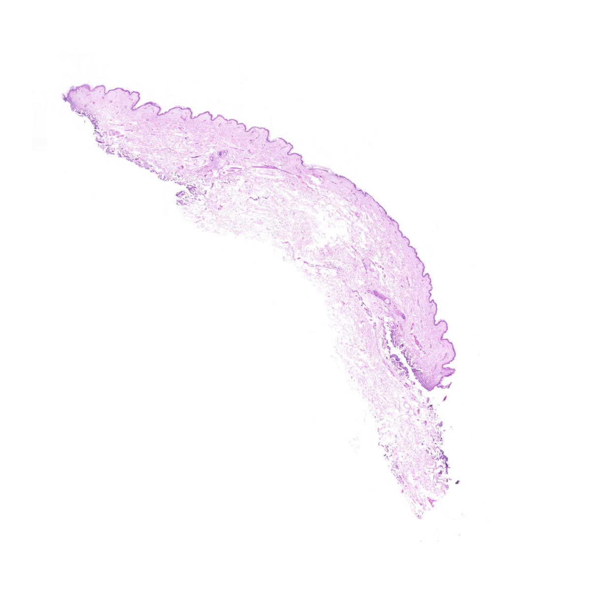 Human FFPE NAT Skin Tissue HuN-22-0091B