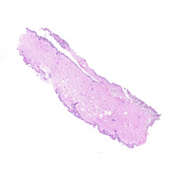 Human FFPE NAT Skin Tissue HuN-22-0093A