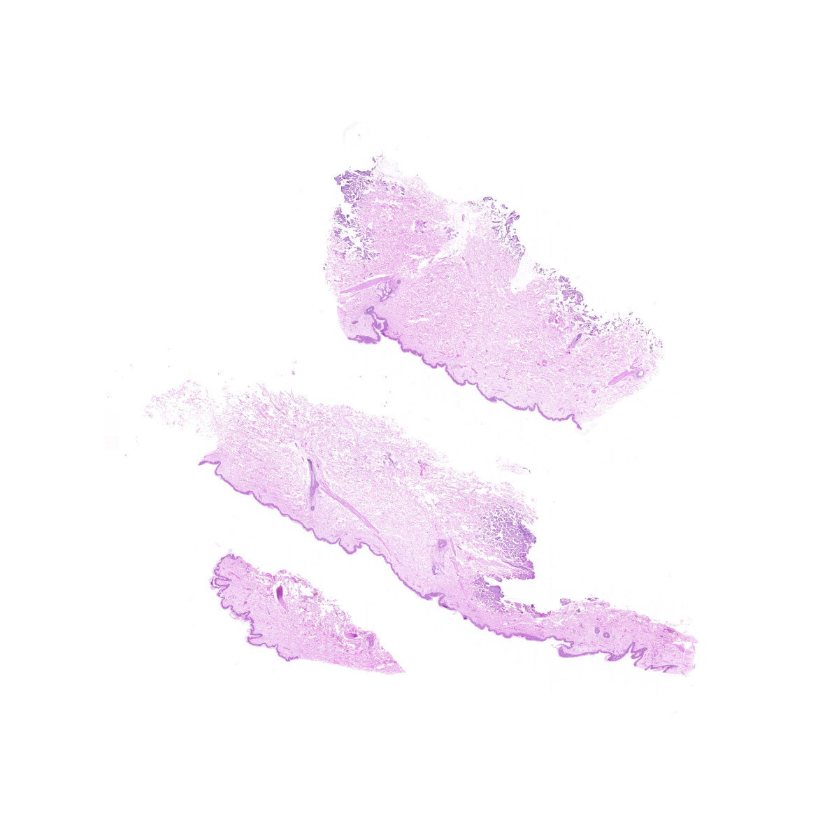Human FFPE NAT Skin Tissue HuN-22-0094