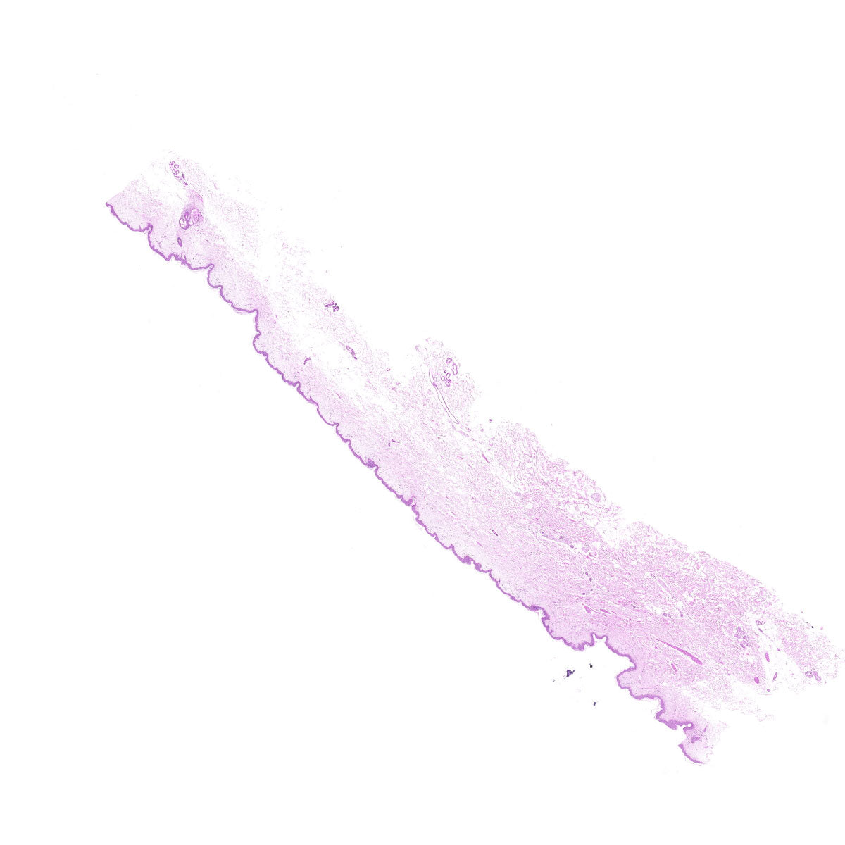 Human FFPE NAT Skin Tissue HuN-22-0144B