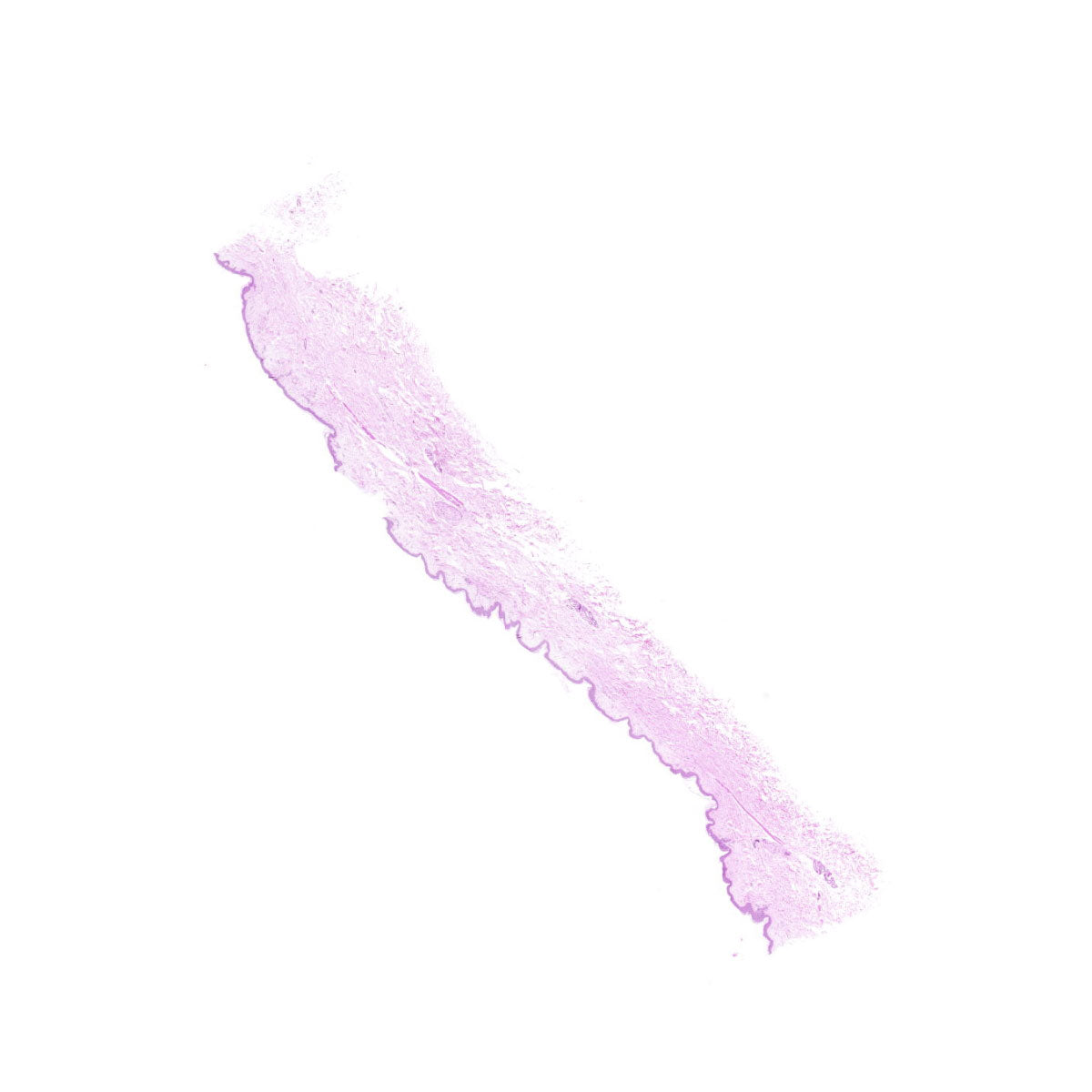 Human FFPE NAT Skin Tissue HuN-22-0147A