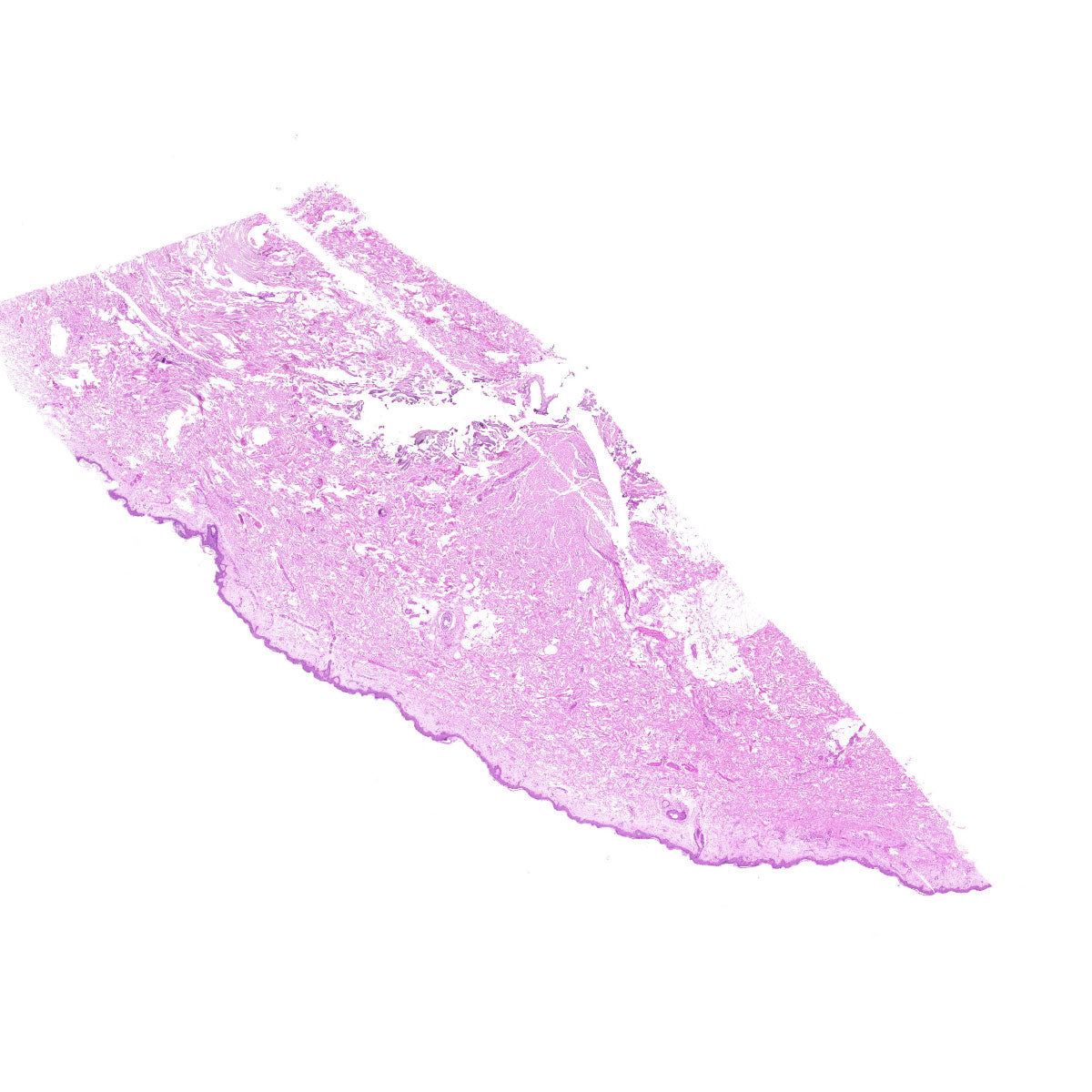 Human FFPE NAT Skin Tissue HuN-22-0148A